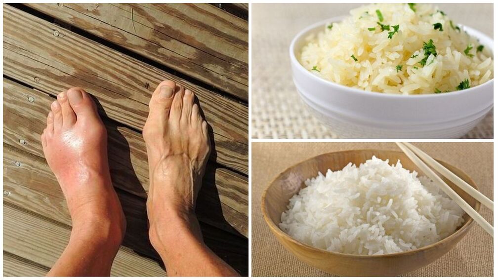 Rice-based diet is recommended for patients with gout. 